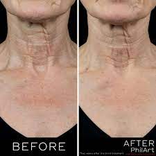 PhilArt neck treatment, anti ageing treatment, lichfield aesthetics, Day Aesthetics, PhilArt before and after