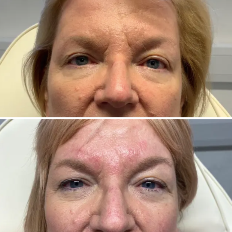 Frown lines botox treatment - Day Aesthetics Lichfield
