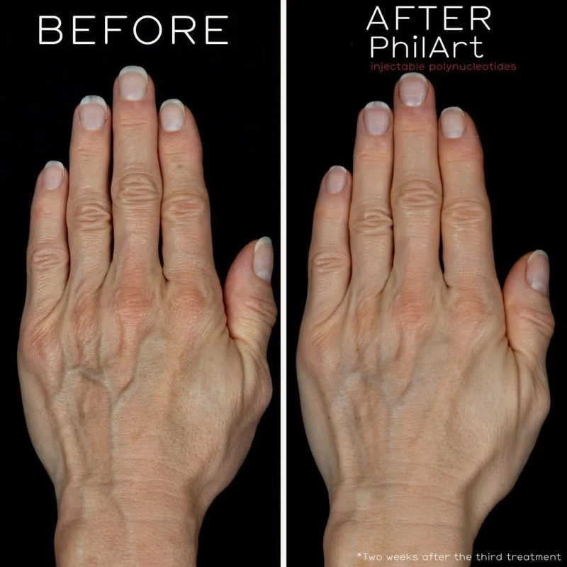 PhilArt hand treatment, anti ageing treatment, lichfield aesthetics, Day Aesthetics, PhilArt before and after
