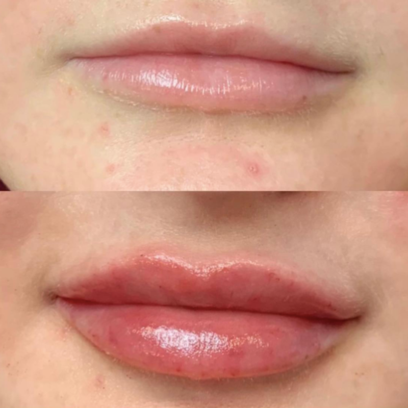 lip filler before and after lichfield